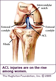 ACL injuries are on the rise among women.